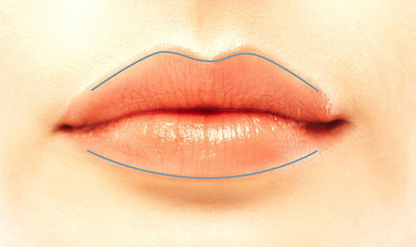 Aufspritzen der Lippenlinie/Lippenkontur mit Hyaluronsäure Aufspritzen der Lippenlinie/Lippenkontur mit Hyaluronsäure