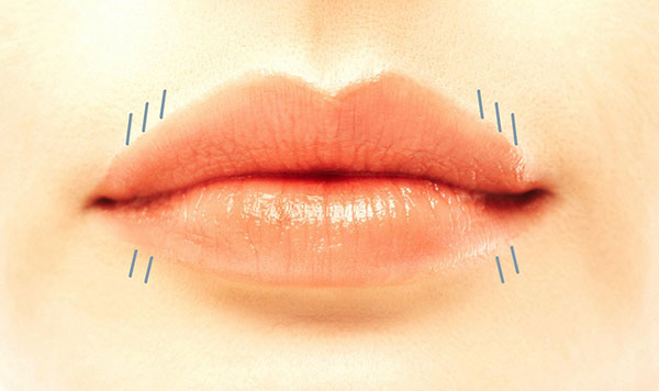 Aufspritzen der Lippenfalten (Raucherfalten) mit Hyaluronsäure Aufspritzen der Lippenfalten (Raucherfalten) mit Hyaluronsäure