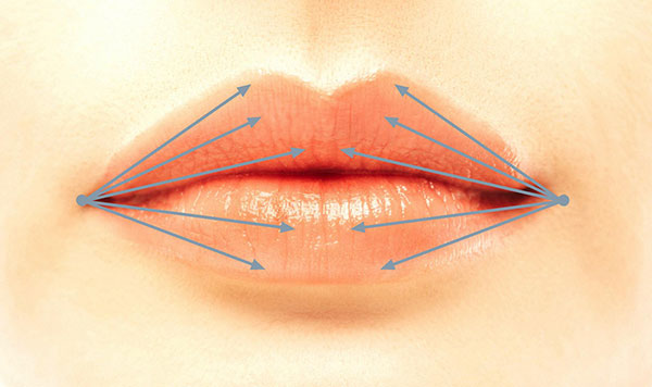 Lippenaufspritzen durch Fächertechnik mit der Mikrokanüle Lippenaufspritzen durch Fächertechnik mit der Mikrokanüle