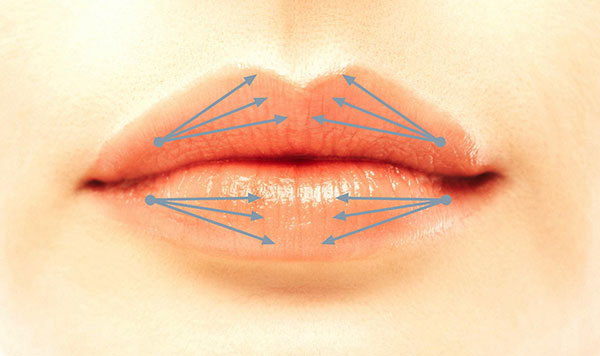 Lippenaufspritzen durch Fächertechnik mit der Nadel Lippenaufspritzen durch Fächertechnik mit der Nadel