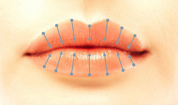 Lippenaufspritzen mit der senkrechten Technik Lippenaufspritzen mit der senkrechten Technik