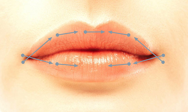 Longitudinale Lippenaufspritztechnik Longitudinale Lippenaufspritztechnik